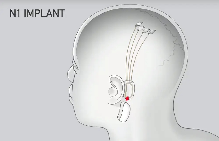 Rajkotupdates.News : Elon Musk In 2022 Neuralink Start To Implantation Of Brain Chips In Humans